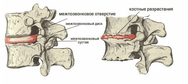 Уменьшение высоты межпозвоночного диска