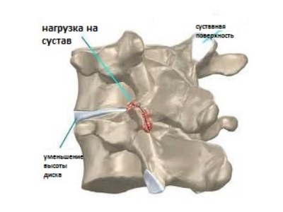 Уменьшение высоты межпозвоночного хряща — противопоказание к нуклеопластике