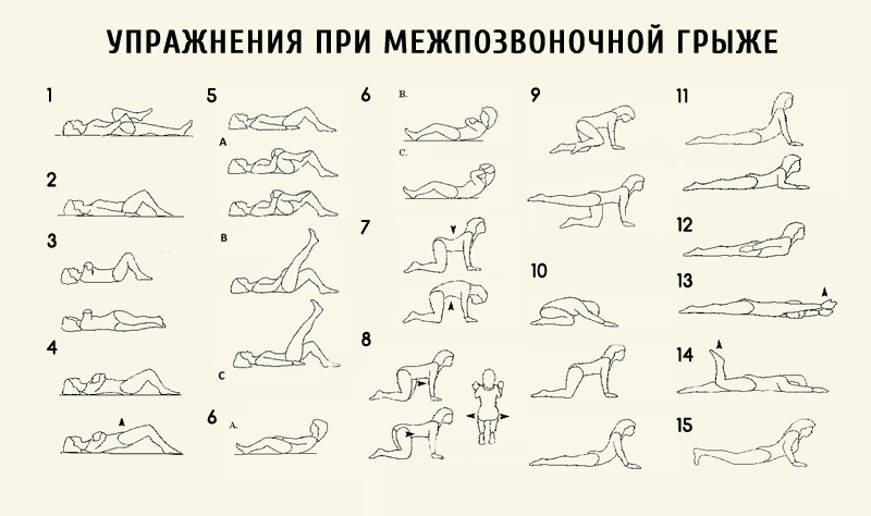 Упражнения при грыже позвоночника