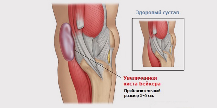 Увеличенная киста Бейкера
