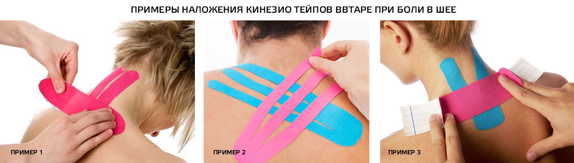 Варианты наложения тейпов на шею