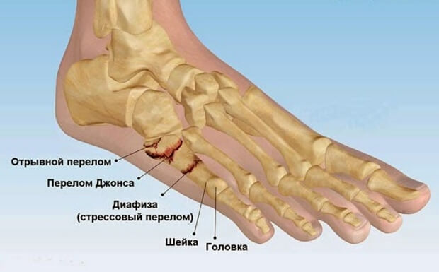 Варианты переломов кости мизинца