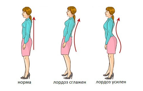 Виды лордоза 