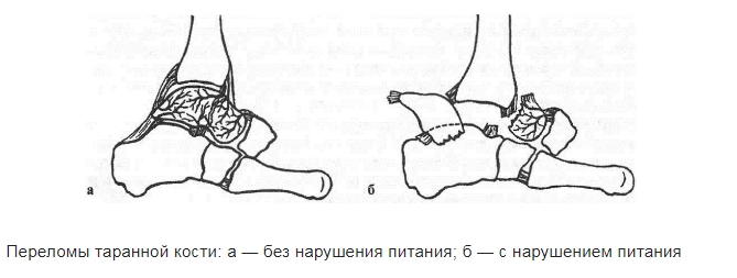 Виды переломов таранной кости