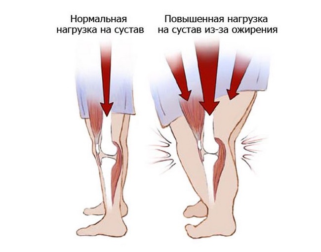 Влияние лишнего веса на суставы