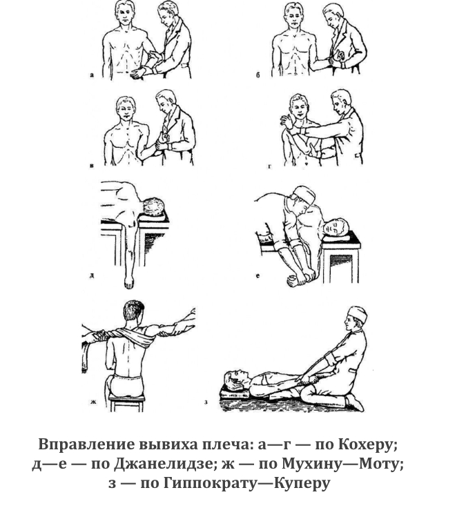 Виды вправления вывиха плеча