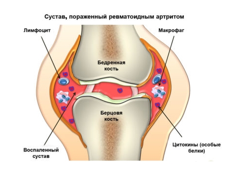 Инфекционное поражение суставов