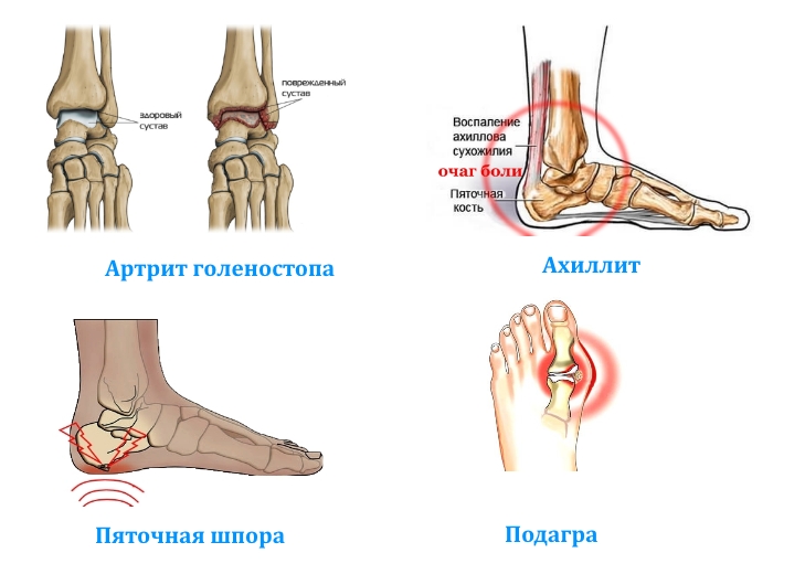 Заболевания голеностопного сустава