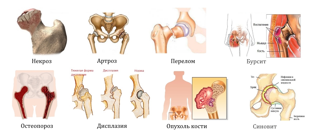 Заболевания и травмы тазобедренного сустава