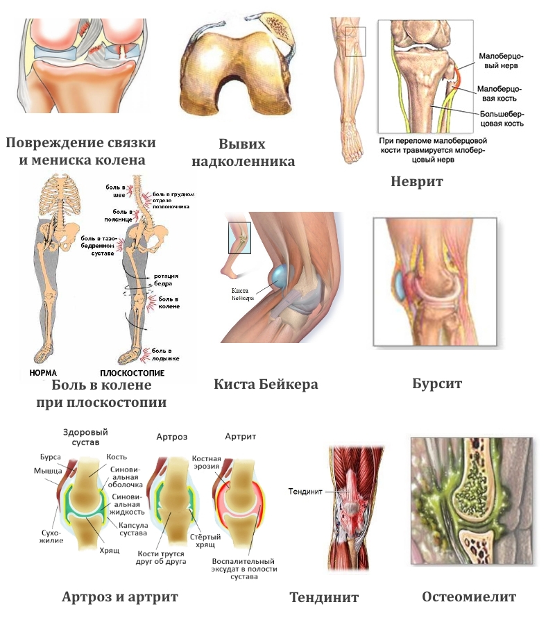 Заболевания колена