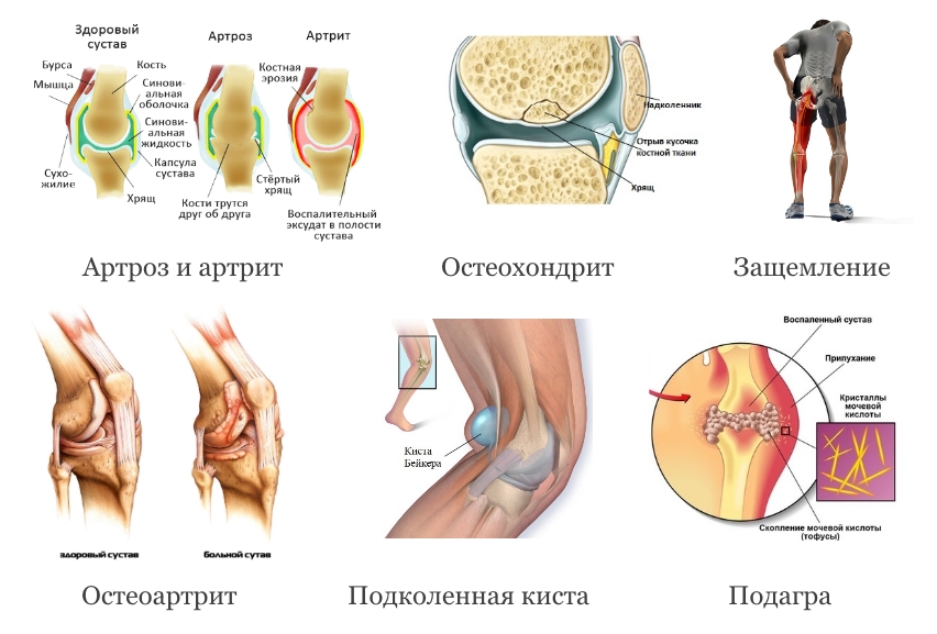 Заболевания коленного сустава