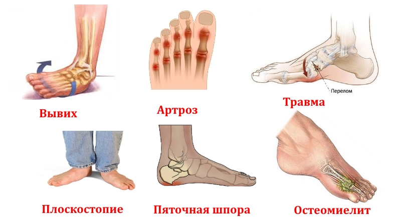Заболевания костей и травмы стопы