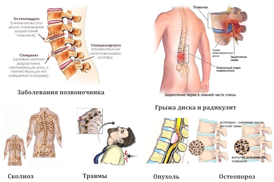 Заболевания и травмы позвоночника