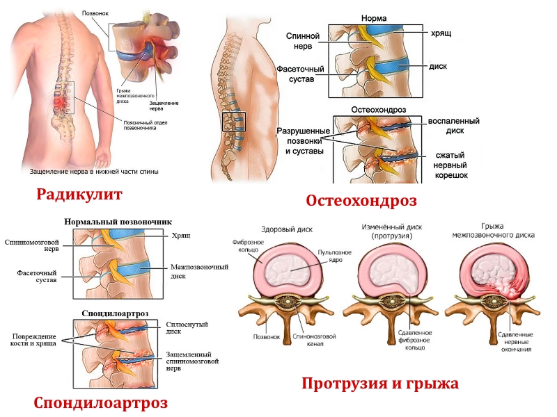 Заболевания поясничного отдела