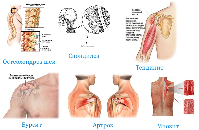 Заболевания при боли в руке