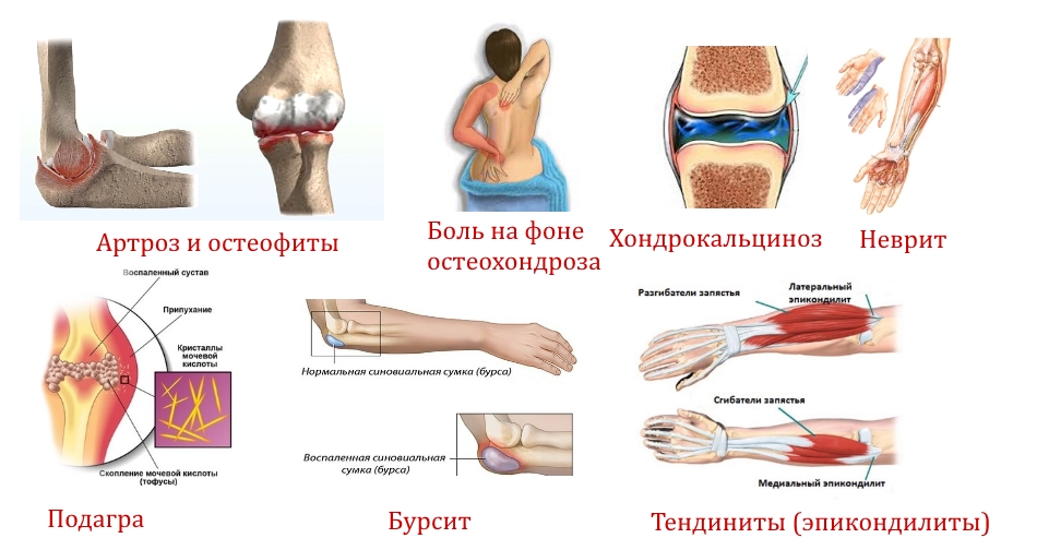 Заболевания — причины боли в локте