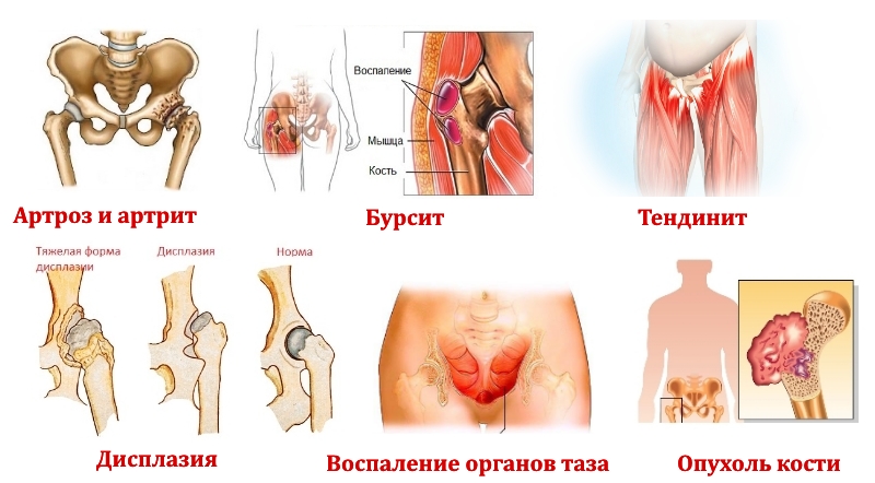 Заболевания — причины боли в области таза и ног