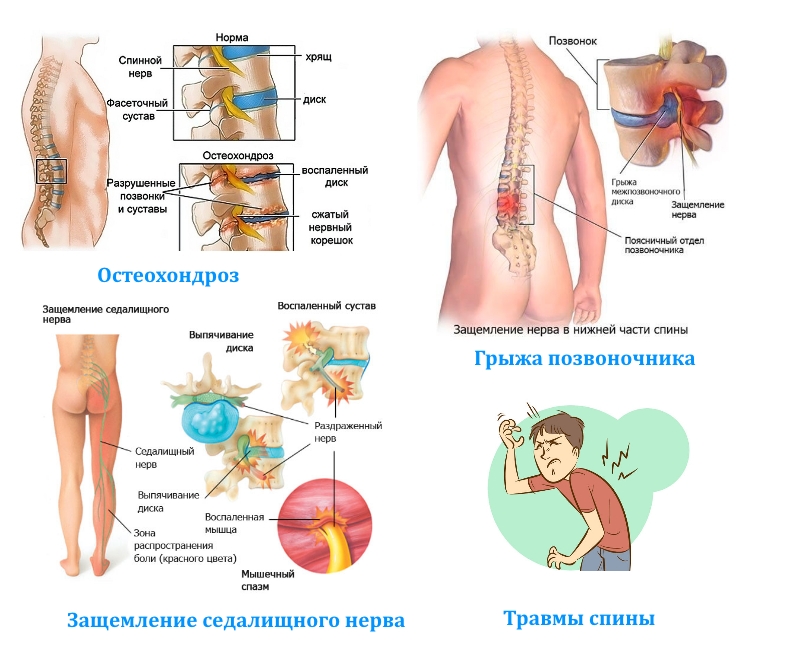 Заболевания-причины боли в спине