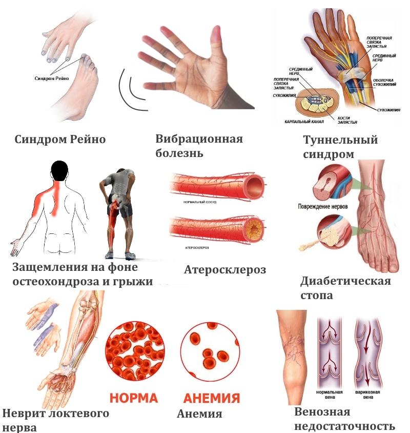 Заболевания — причины онемения конечностей