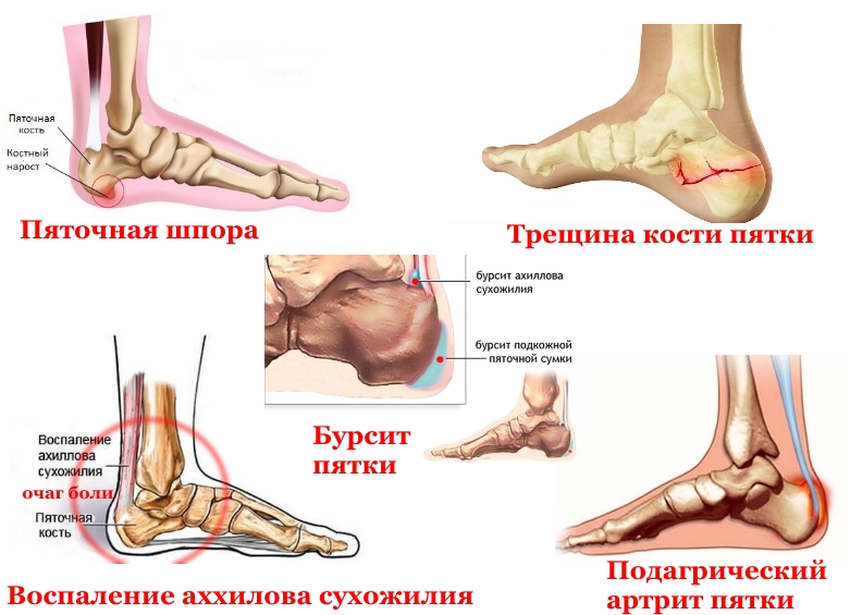 Заболевания пятки