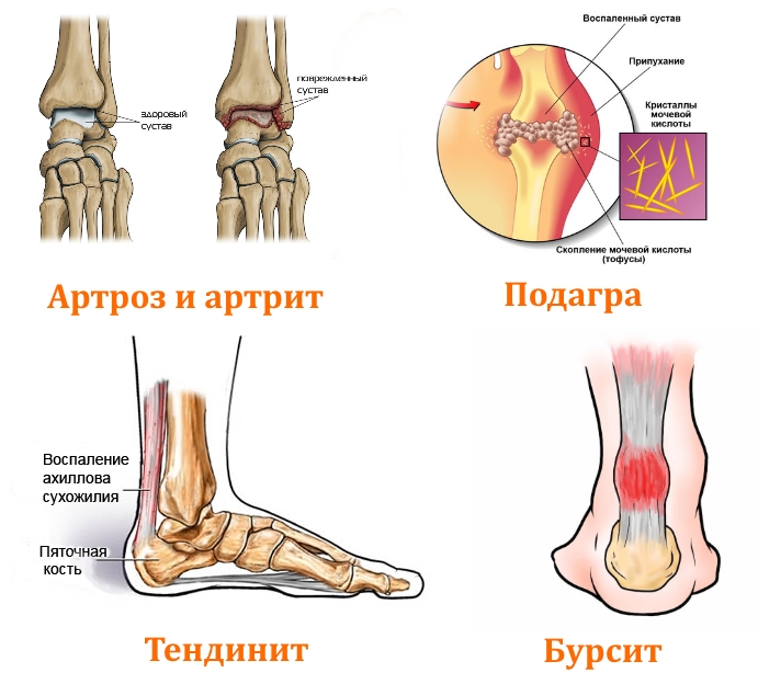 Заболевания щиколотки