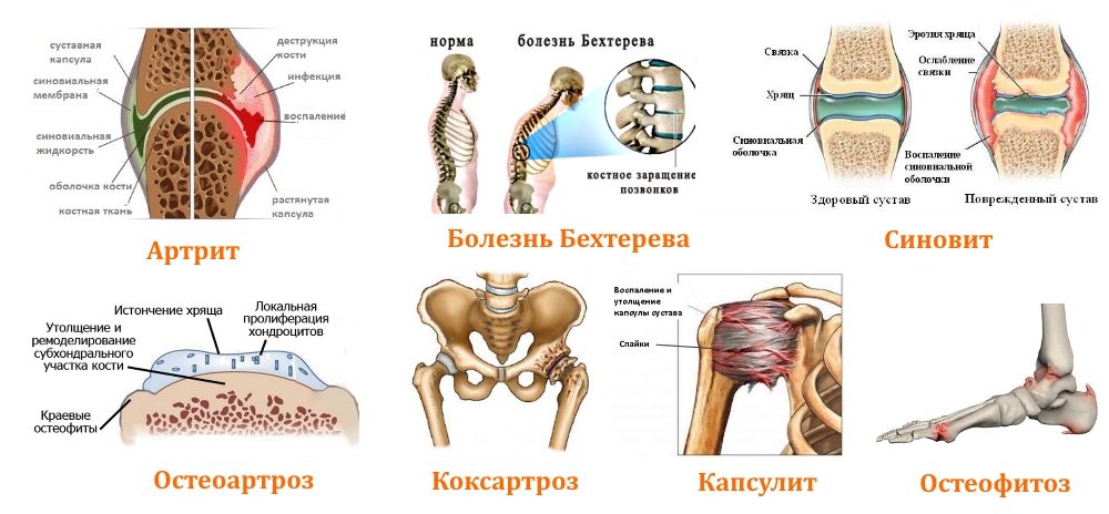 Заболевания, сопровождающие скованность