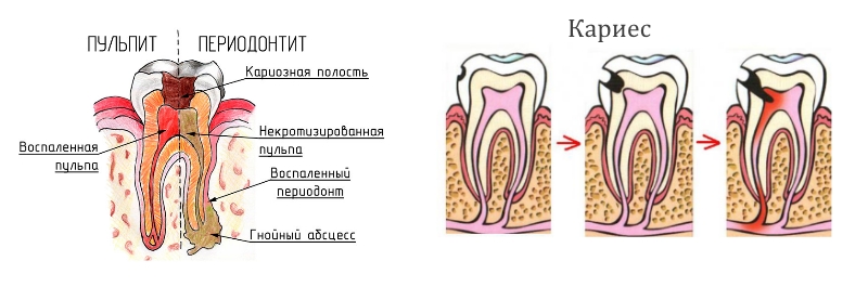 Заболевания зубов