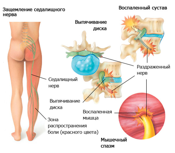 Защемление седалищного нерва при грыже