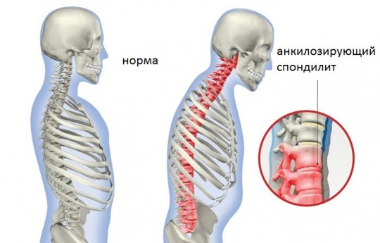 Анкилозирующий спондилит