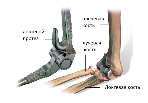 Схема эндопротезирования локтевого сустава