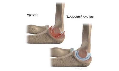 Артрит локтевого сустава