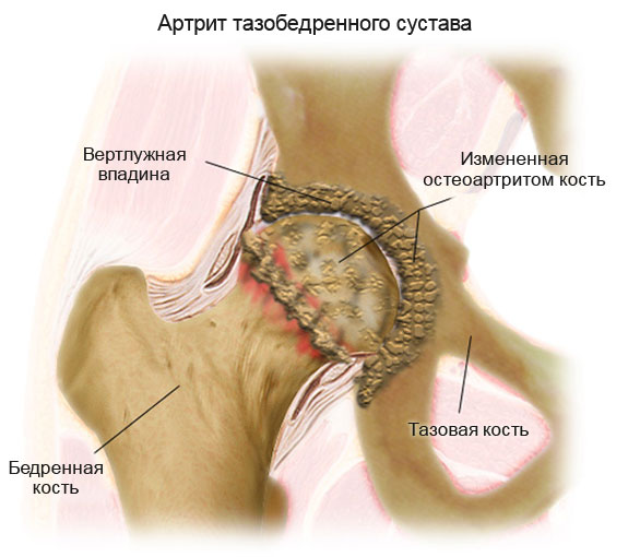 Артрит тазобедренного сустава