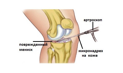 Артроскопия мениска