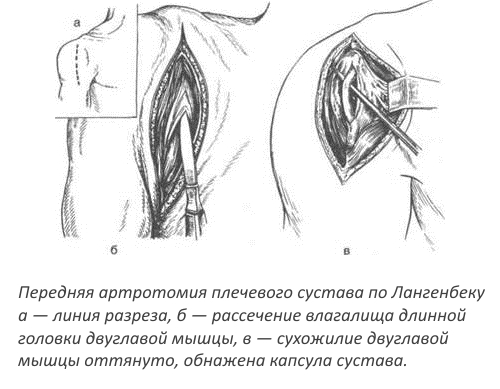 Артротомия Лангенбека плечевого сустава