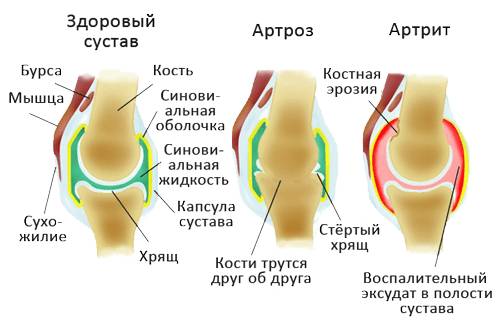 Артроз и артрит коленного сустава