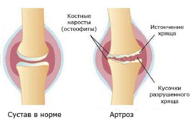 Артроз сустава