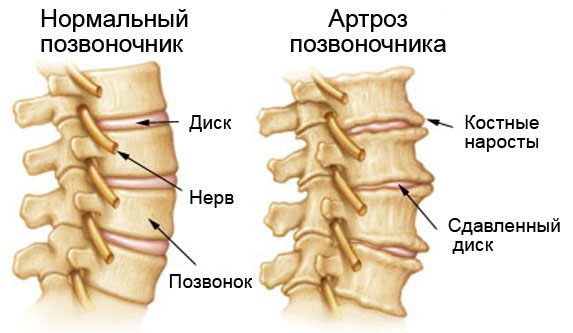 Схема артроза позвоночника