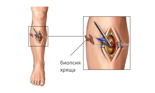 Биопсия хряща