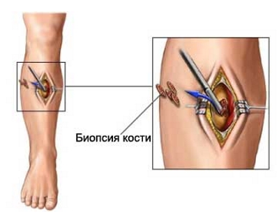 Биопсия саркомы Юинга