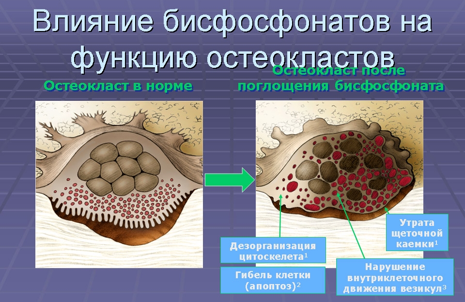 Действие бисфосфонатов