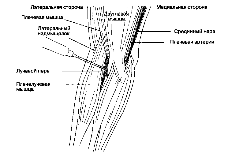 Блокада боли локтевого нерва