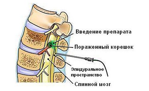 Блокада боли при люмбоишиалгии