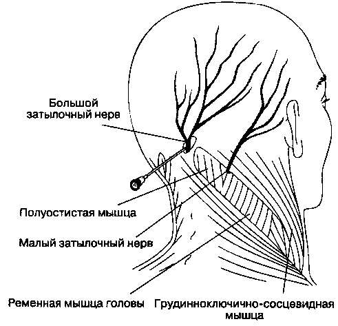 Блокада затылочного нерва