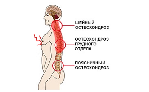 Очаги остеохондроза