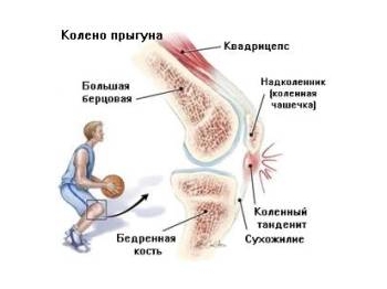 Боль вследствие нагрузки