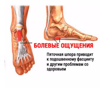 Болевые ощущения при пяточной шпоре