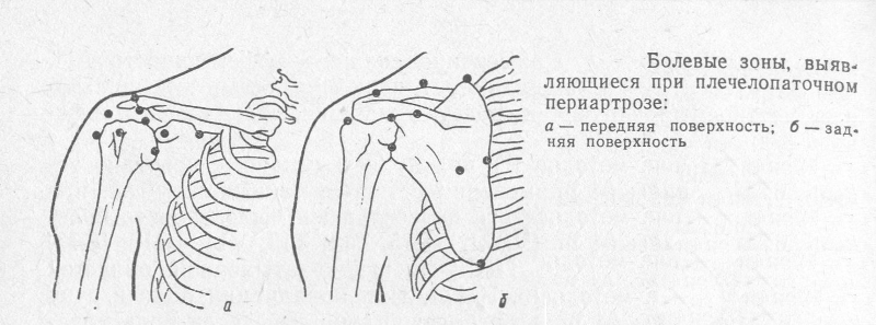 Болевые зоны при периартрозе