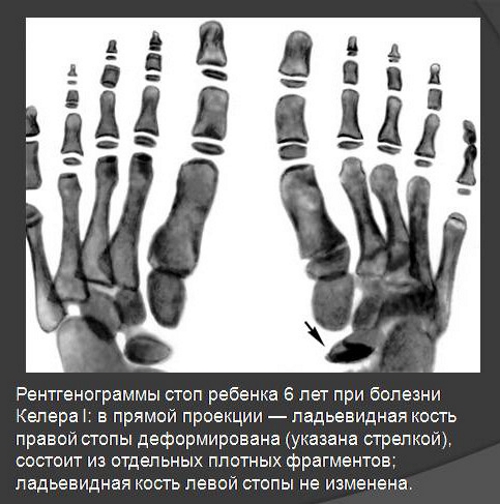 Болезнь Келлера 1 вида на рентген снимке