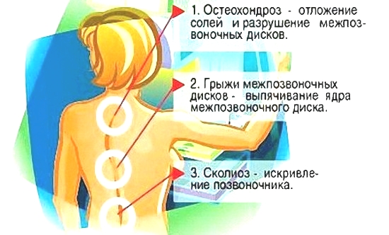 Частые причины боли в спине