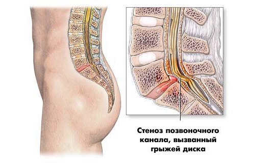 Дегенеративный стеноз позвоночного канала